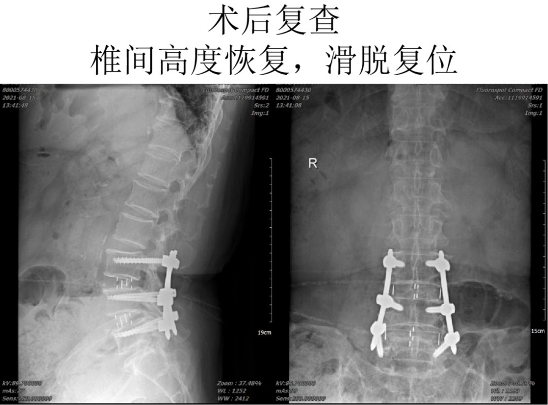 结果显示患者腰椎椎管狭窄(l3/4,l4/5椎间盘突出,l4椎体前滑脱),与此