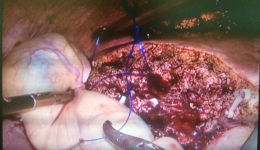 普外科肝胆外科团队完成我院首例腹腔镜肝癌切除术