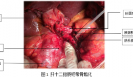 普外科肝胆专业组完成1例扩大胰十二指肠切除术