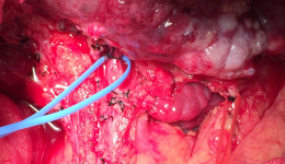 普通外科顺利实施首例规则性左半肝切除术