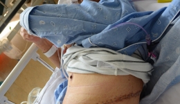 我院胸外科成功为85岁高龄患者进行食管癌根治术