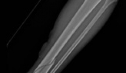 创伤骨科新技术