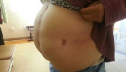 普外科成功完成青岛市首例巨大切口疝修补术