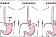 仁医妙手除顽疾 ——记一例胸外科腹腔镜食管裂孔疝修补+胃底折叠术