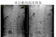 神经外科王志刚教授团队开展腰椎微创融合新技术——OLIF手术 疗效显著