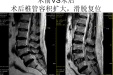 妙手再除沉疴！82岁患者腰椎管狭窄，我院神经外科成功实施微创治疗