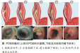 消化内科完成两例贲门失弛缓症困难POEM术