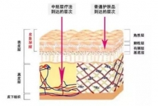 中胚层、美塑、微针、水光针…到底是什么？