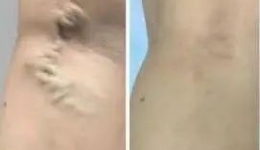 腿上的静脉曲张能消失不见？