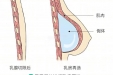 术业求精 | 普通外科成功开展乳腺癌术后一期乳房再造手术