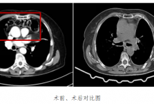 术业求精 共庆十年 | 我院胸外科成功救治一例罕见心包内膈疝患者