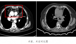 术业求精 共庆十年 | 我院胸外科成功救治一例罕见心包内膈疝患者