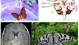 献礼十周年 术业求精 | 微创小切口 横扫“蝴蝶瘤”