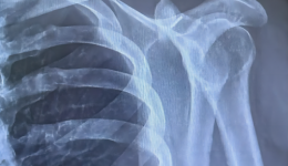 术业求精 | 我院成功开展全关节镜下肩锁关节脱位微创手术