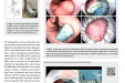 消化内科在牵引辅助内镜切除领域取得系列研究成果