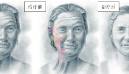 肉毒毒素只能用在除皱上？那你浅薄了