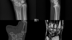 3D打印、数字医学、显微外科——这场手术充满了高精尖词汇