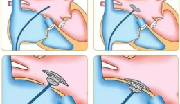 精准定位 一伞双孔——我院心内科完成一例双孔房缺封堵治疗