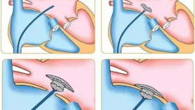 精准定位 一伞双孔——我院心内科完成一例双孔房缺封堵治疗