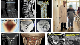 我院脊柱外科连续为两例复杂性寰枢椎脱位患者实施后路定量复位融合内固定术