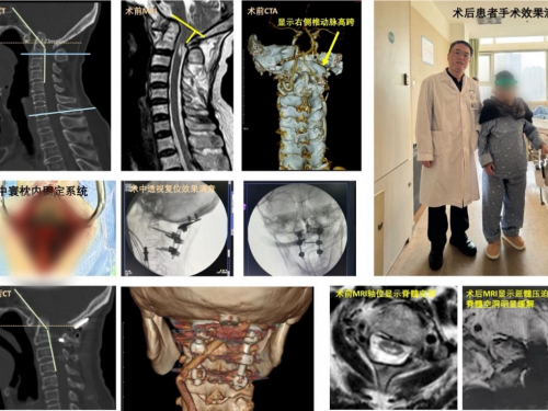 我院脊柱外科连续为两例复杂性寰枢椎脱位患者实施后路定量复位融合内固定术