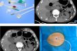 介入新技术系列（一）：我院介入科开展CT引导下胃造瘘术