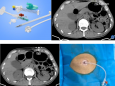 介入新技术系列（一）：我院介入科开展CT引导下胃造瘘术