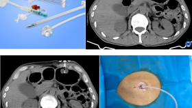 介入新技术系列（一）：我院介入科开展CT引导下胃造瘘术