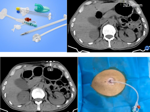 介入新技术系列（一）：我院介入科开展CT引导下胃造瘘术