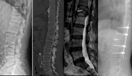 小切口完成大手术：脊柱转移瘤分离手术