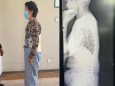 让患者挺直脊梁——我院脊柱外科顺利完成一例严重脊柱后凸截骨矫形手术