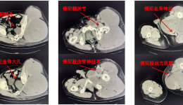 骨盆长出大恶瘤，“截”后重生创奇迹