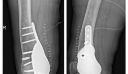 软骨肉瘤，虽罕见，但切莫大意