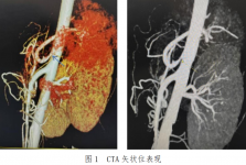 我院普通外科胃肠胰外科专业成功完成一例腹腔镜下正中弓状韧带松解+腹腔干周围神经节切除术