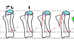 告别拇外翻，重拾矫健步伐！