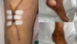 显微外科技术助力打破慢性跟骨骨髓炎治疗困局