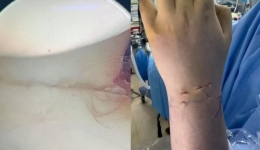 腕关节镜下微创复位：舟骨骨折治疗的新曙光