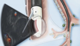 呼吸与危重症医学科开展无痛 EBUS-TBNA新技术，开启呼吸疾病诊疗新篇章