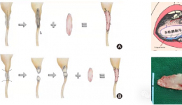 再接再励！齐鲁医院连续“移花接木”破输尿管狭窄难题！