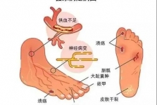 我院核医学科创新应用“99mTc-MIBI下肢微循环核素显像技术”助力糖尿病足精准诊疗