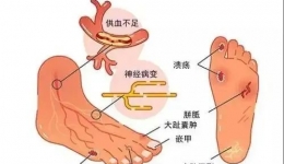我院核医学科创新应用“99mTc-MIBI下肢微循环核素显像技术”助力糖尿病足精准诊疗