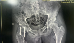 38岁的他，住进了小儿骨科病房