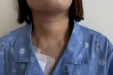 我院咽喉与甲状腺外科完成锁骨下入路腔镜下巨大甲状腺肿瘤切除术