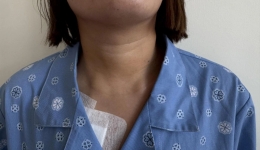 我院咽喉与甲状腺外科完成锁骨下入路腔镜下巨大甲状腺肿瘤切除术