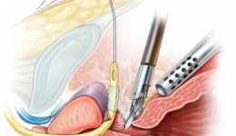 机器人手术之前列腺癌根治术