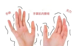 手麻无力？不要忽略隐形的警告——肘管综合征