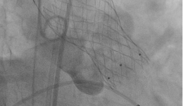 健康科普 | 不开胸也能换“心门”，老年人的心脏有救了