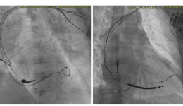 CRT-D重启心脏奇迹，全病程管理护航生命新生——山东大学齐鲁医院（青岛）开启心衰治疗新篇章