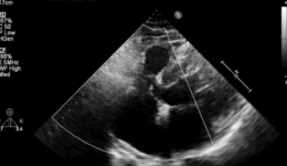 左右开弓 一箭双封——复合影像引导下复杂双孔室间隔缺损的介入封堵之路