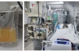山东大学齐鲁医院（青岛）重症医学科成功开展双重血浆置换技术，为重症患者救治再添利器